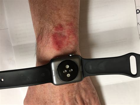 smart watch rash on wrist.